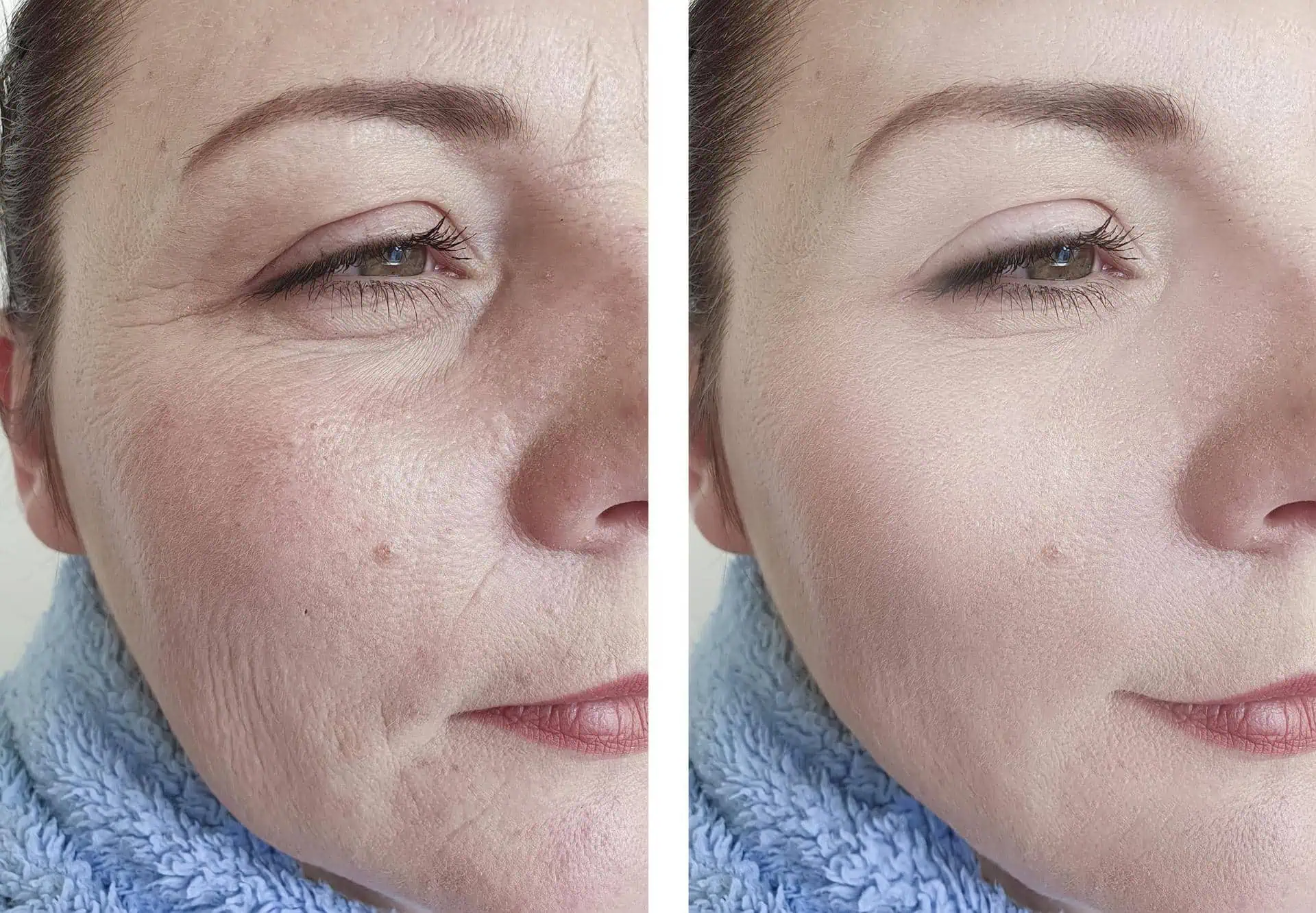 Ženy, chcete BOTOX bez ihiel? Vezmite 2 Eurá a choďte do lekárne, tento lacný produkt robí zázraky!