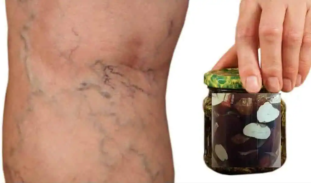 Mám 51 rokov a už ma konečne netrápia KŔČOVÉ ŽILY: Pomohol mi mamin zázračný domáci recept!