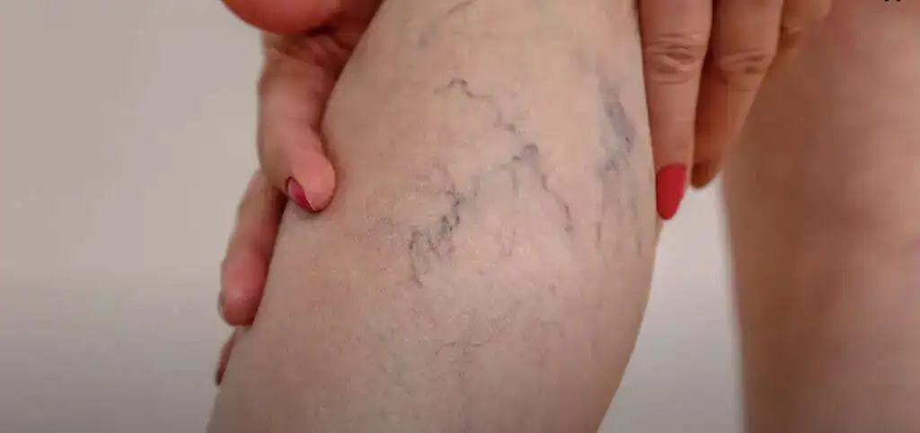 Trápia vás boľavé nohy a zvlášť kŕčové žily? Musíte skúsiť, čo dokáže tento starý recept!